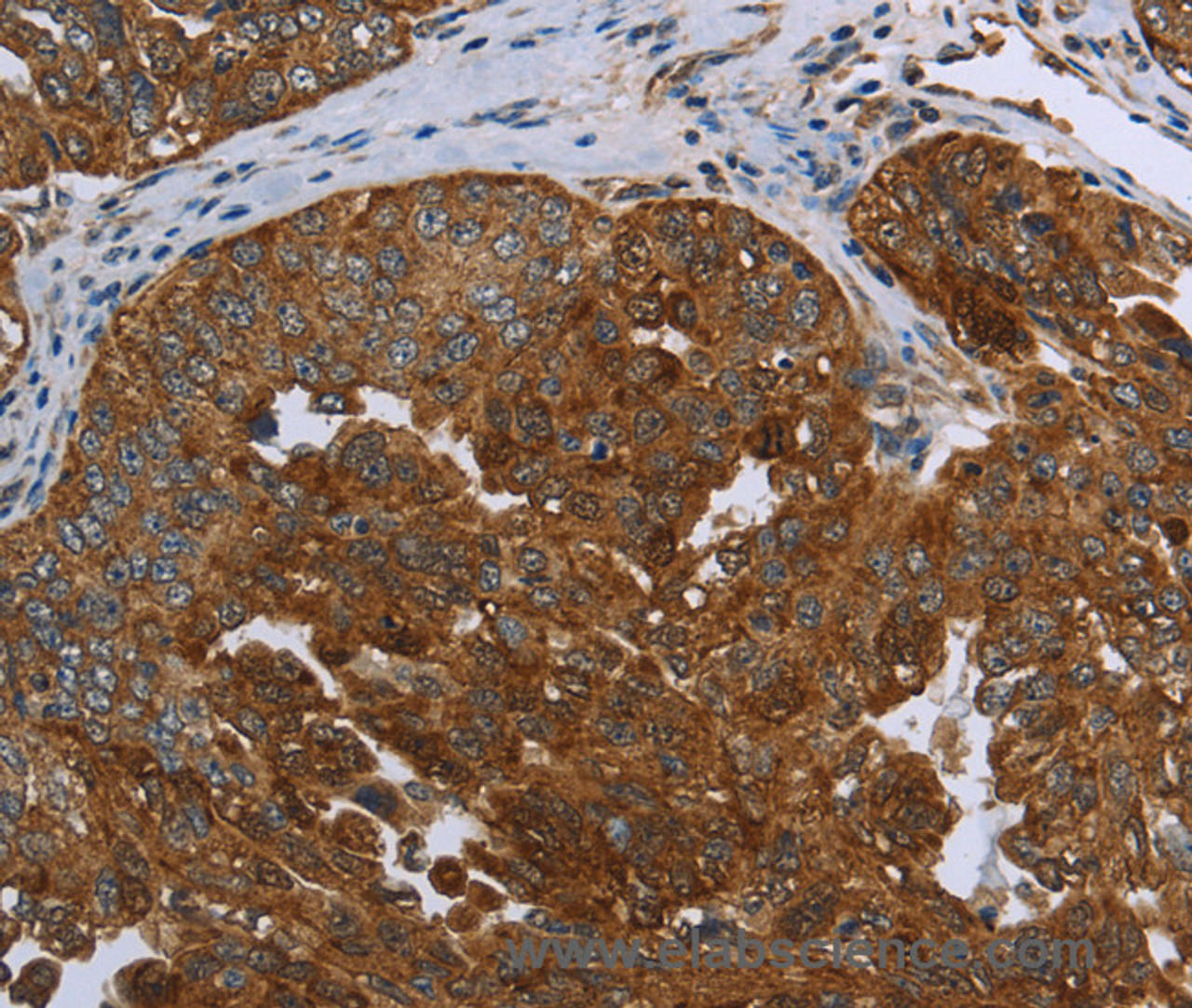 Immunohistochemistry of paraffin-embedded Human ovarian cancer using SNCG Polyclonal Antibody at dilution of 1:60