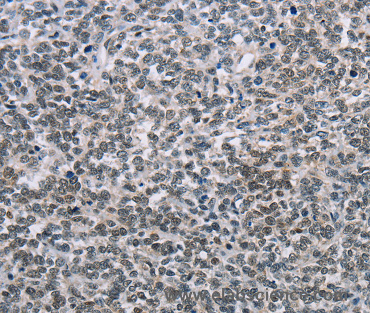 Immunohistochemistry of paraffin-embedded Human ovarian cancer tissue using TONSL Polyclonal Antibody at dilution 1:60