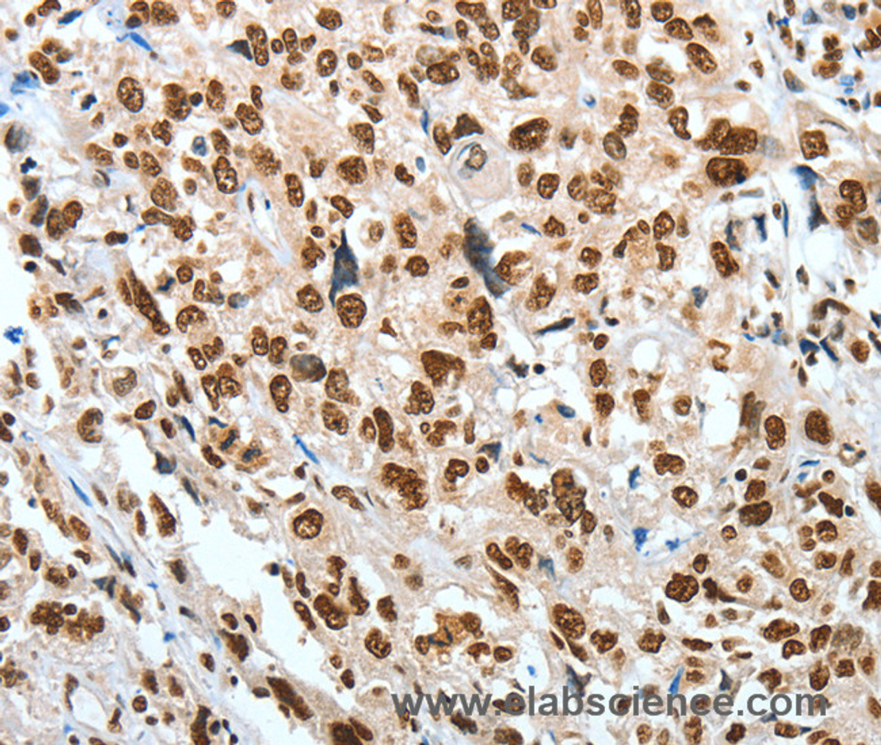 Immunohistochemistry of paraffin-embedded Human esophagus cancer using BNIP1 Polyclonal Antibody at dilution of 1:60