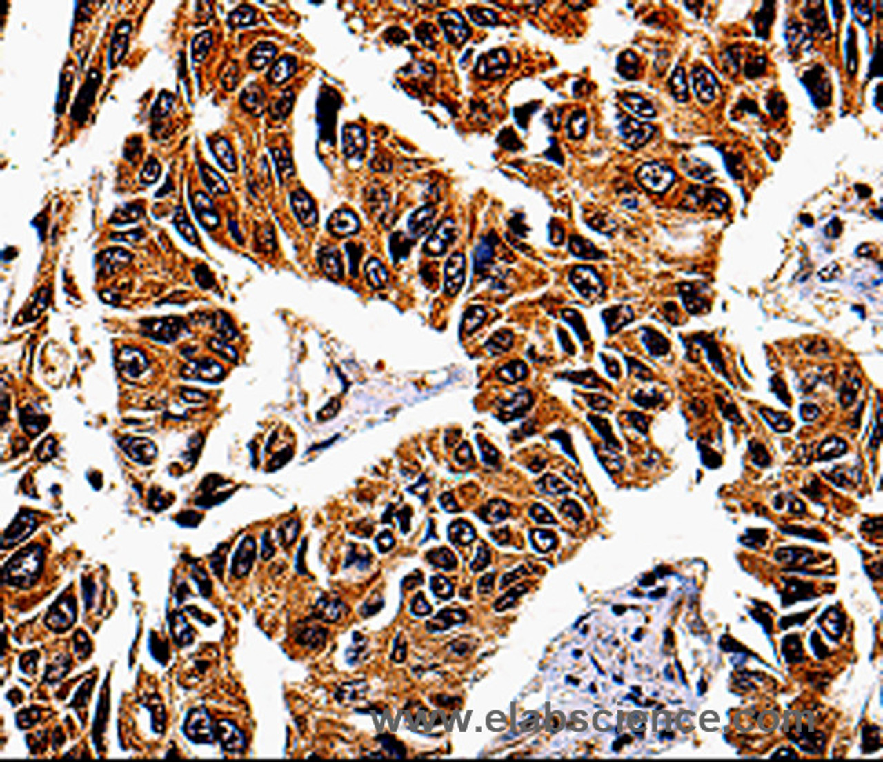 Immunohistochemistry of paraffin-embedded Human lung cancer tissue using IL13RA1 Polyclonal Antibody at dilution 1:50