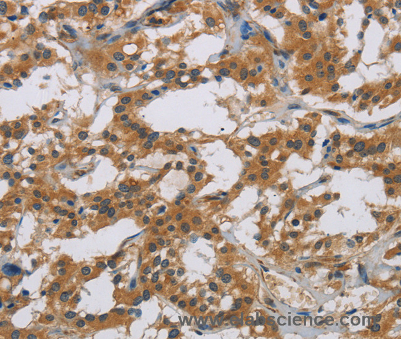 Immunohistochemistry of paraffin-embedded Human thyroid cancer tissue using IL18R1 Polyclonal Antibody at dilution 1:40
