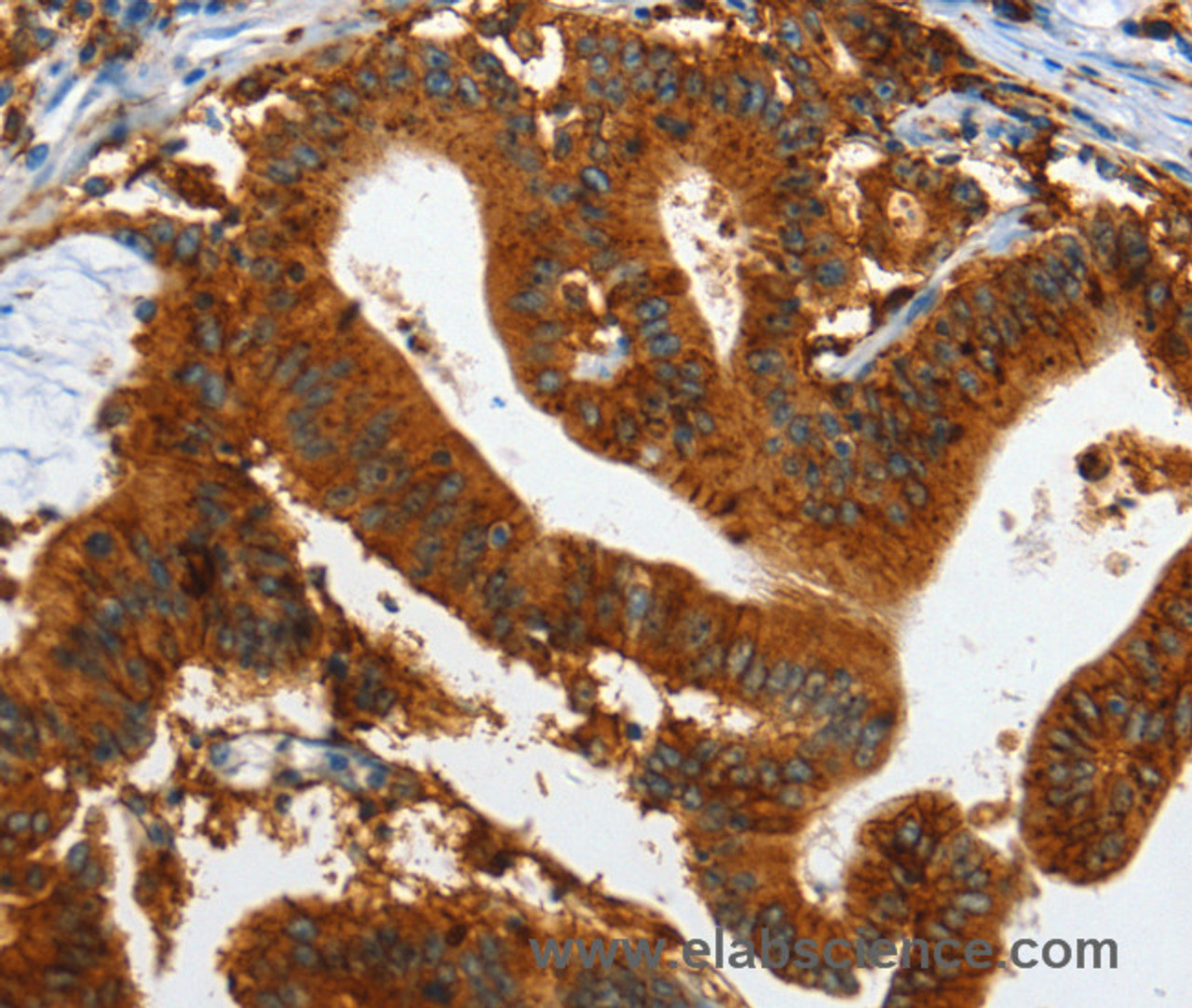Immunohistochemistry of paraffin-embedded Human colon cancer tissue using IL20RA Polyclonal Antibody at dilution 1:35