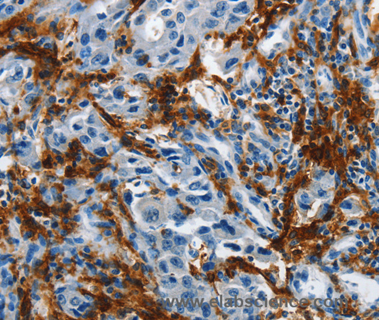 Immunohistochemistry of paraffin-embedded Human lung cancer tissue using IL20RA Polyclonal Antibody at dilution 1:35