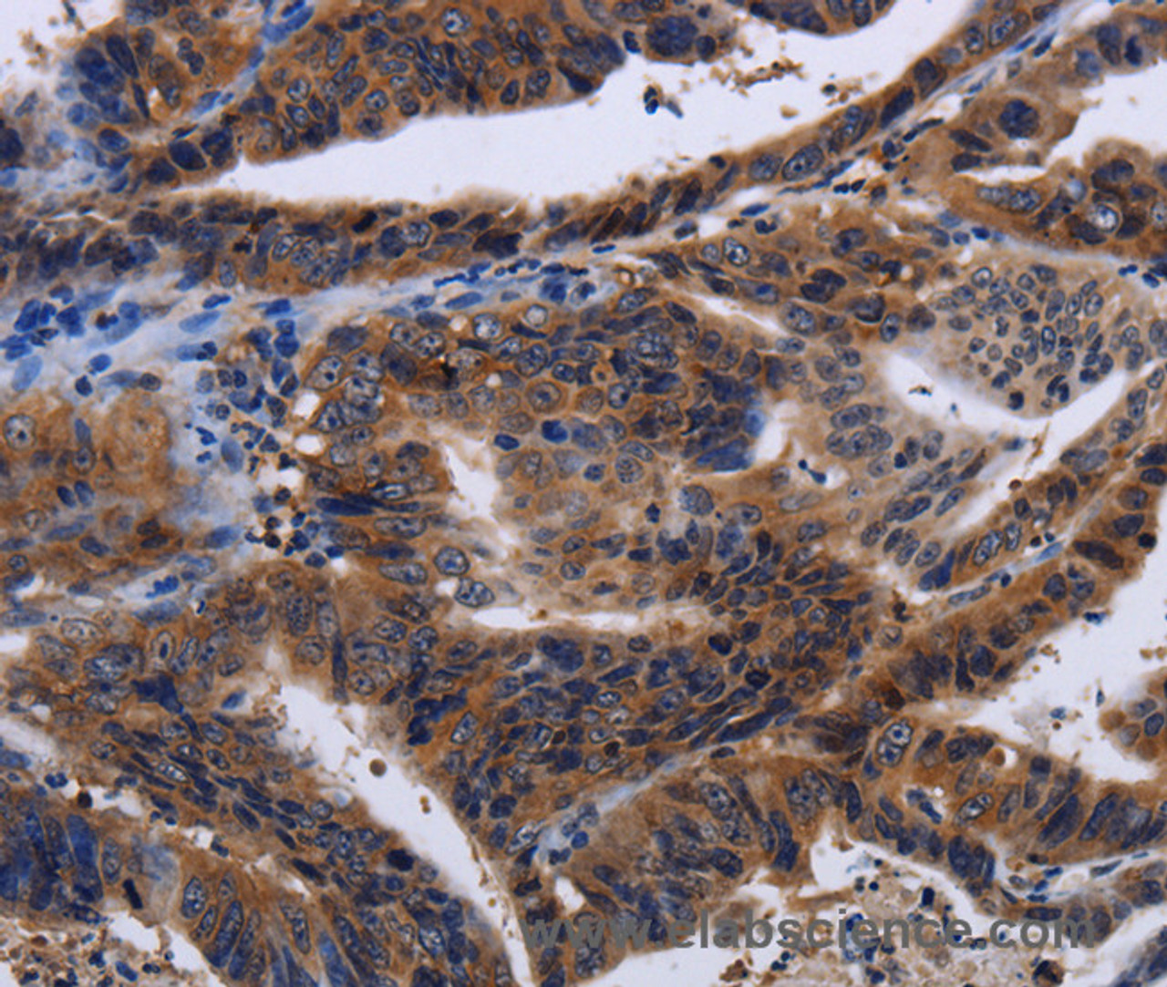 Immunohistochemistry of paraffin-embedded Human gasrtic cancer tissue using HTR2B Polyclonal Antibody at dilution 1:60