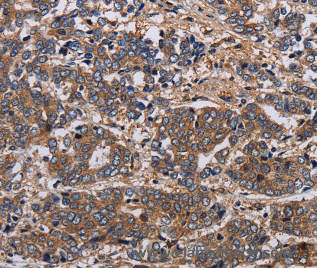 Immunohistochemistry of paraffin-embedded Human liver cancer tissue using HTR2B Polyclonal Antibody at dilution 1:60