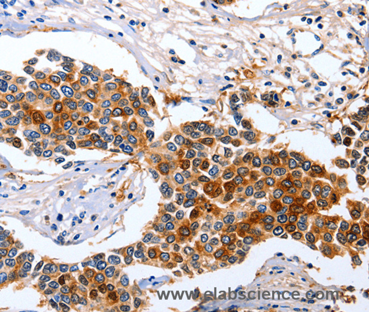 Immunohistochemistry of paraffin-embedded Human breast cancer tissue using GFER Polyclonal Antibody at dilution 1:50