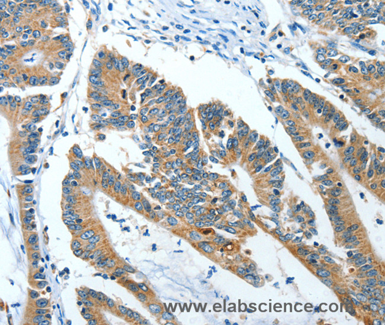 Immunohistochemistry of paraffin-embedded Human colon cancer tissue using ANGPT1 Polyclonal Antibody at dilution 1:50