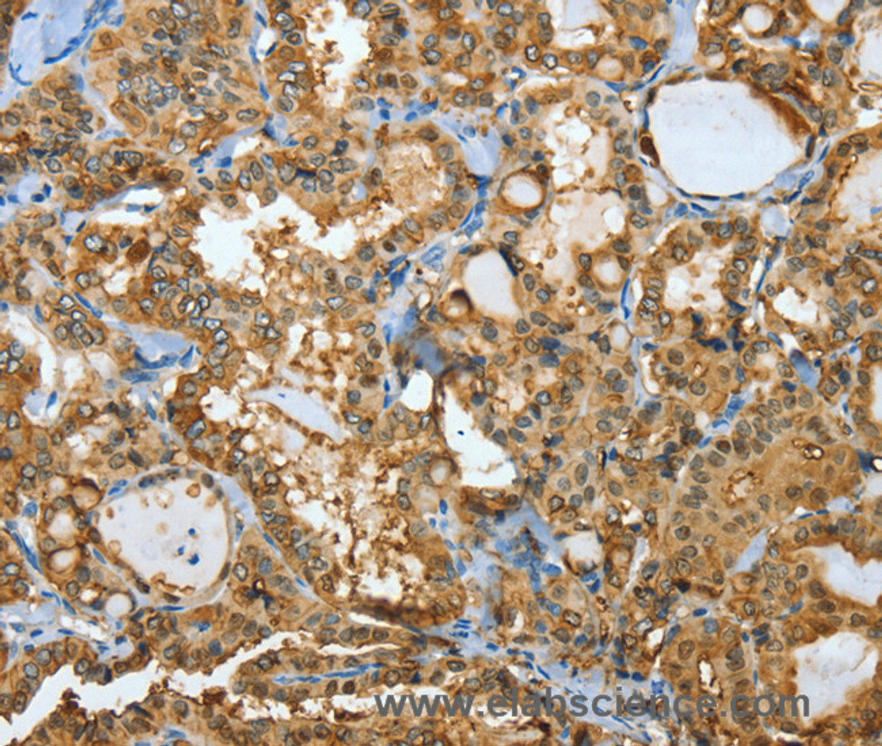 Immunohistochemistry of paraffin-embedded Human thyroid cancer using ANXA3 Polyclonal Antibody at dilution of 1:35