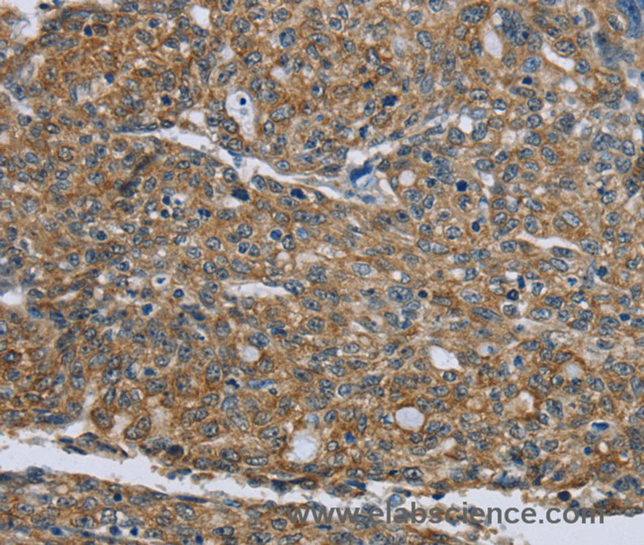 Immunohistochemistry of paraffin-embedded Human ovarian cancer tissue using CK-5 Polyclonal Antibody at dilution 1:30