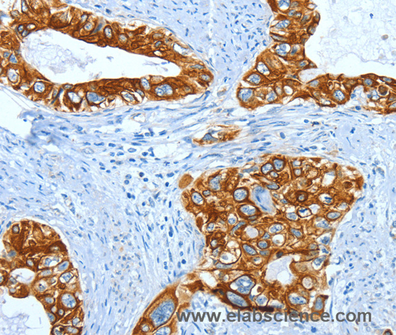 Immunohistochemistry of paraffin-embedded Human cervical cancer using KRT40 Polyclonal Antibody at dilution of 1:50