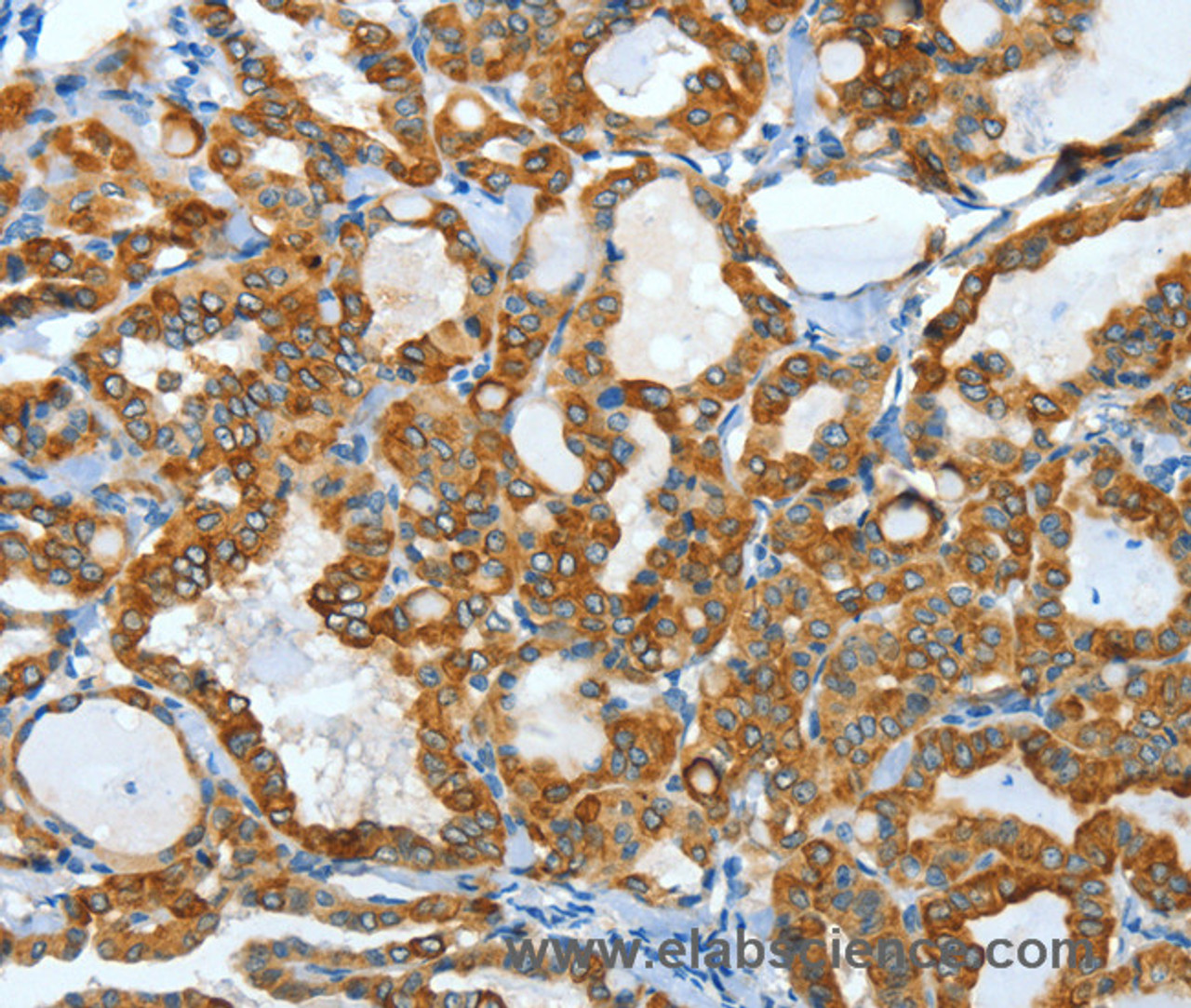 Immunohistochemistry of paraffin-embedded Human thyroid cancer using KRT40 Polyclonal Antibody at dilution of 1:50