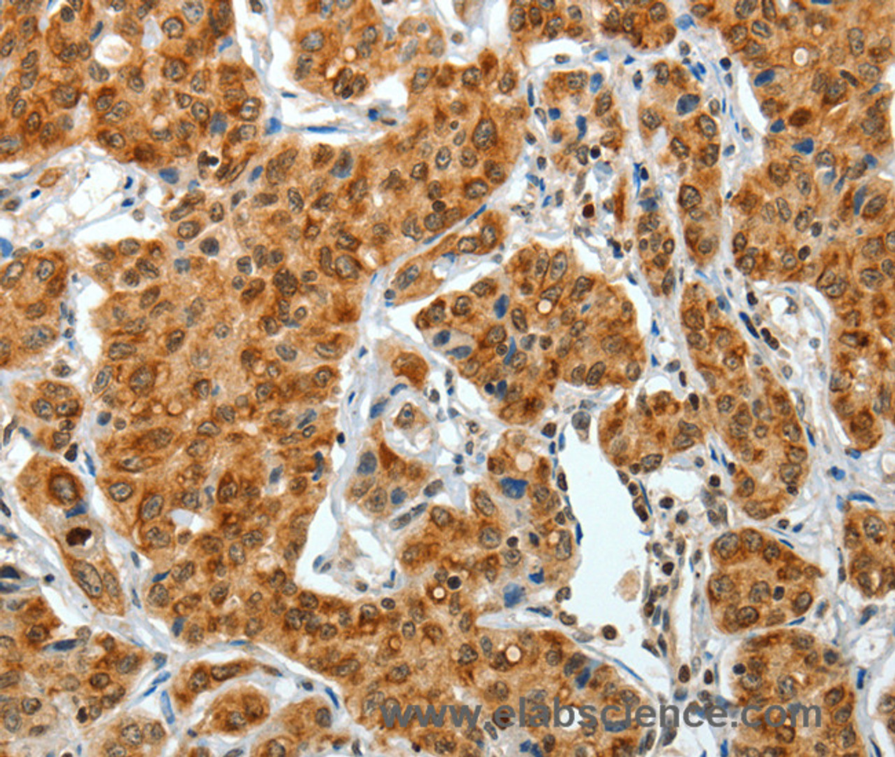 Immunohistochemistry of paraffin-embedded Human lung cancer tissue using COL1A2 Polyclonal Antibody at dilution 1:70