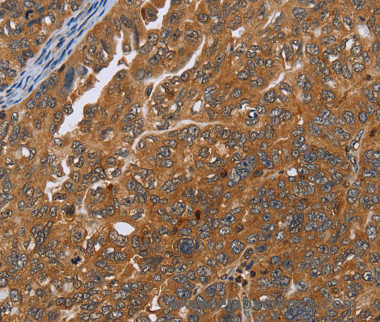 Immunohistochemistry of paraffin-embedded Human ovarian cancer tissue using ADAMTS15 Polyclonal Antibody at dilution 1:40