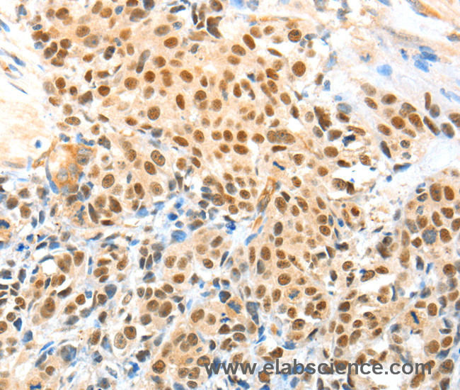 Immunohistochemistry of paraffin-embedded Human esophagus cancer using APPL1 Polyclonal Antibody at dilution of 1:70