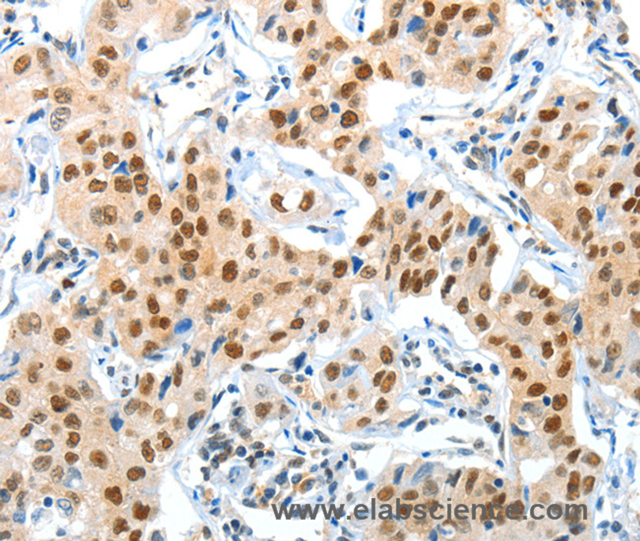 Immunohistochemistry of paraffin-embedded Human lung cancer using APPL1 Polyclonal Antibody at dilution of 1:70