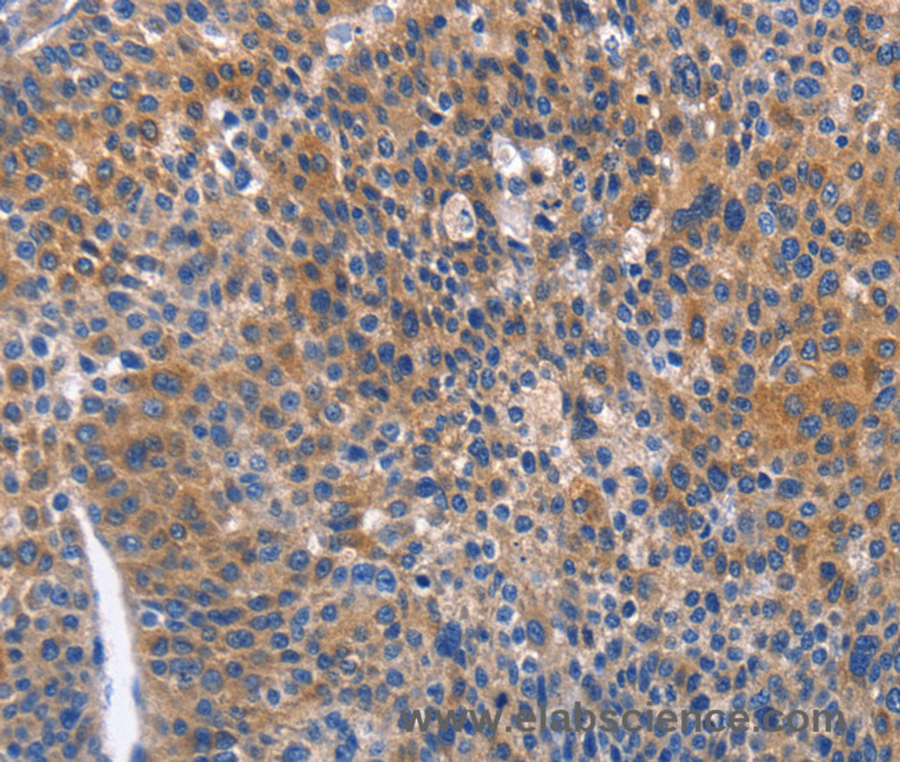 Immunohistochemistry of paraffin-embedded Human liver cancer tissue using ARRB1 Polyclonal Antibody at dilution 1:50