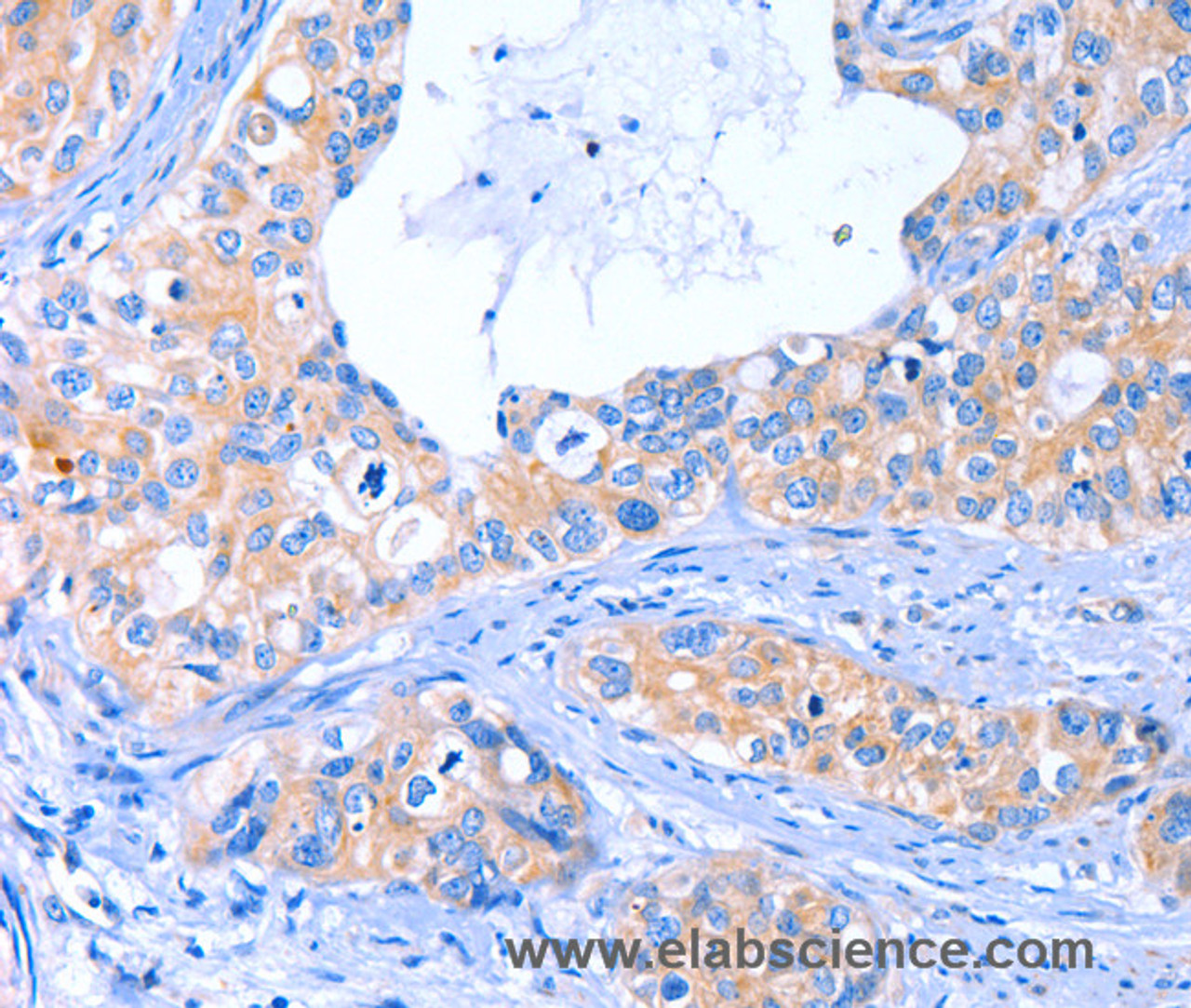 Immunohistochemistry of paraffin-embedded Human cervical cancer tissue using ARRB1 Polyclonal Antibody at dilution 1:50