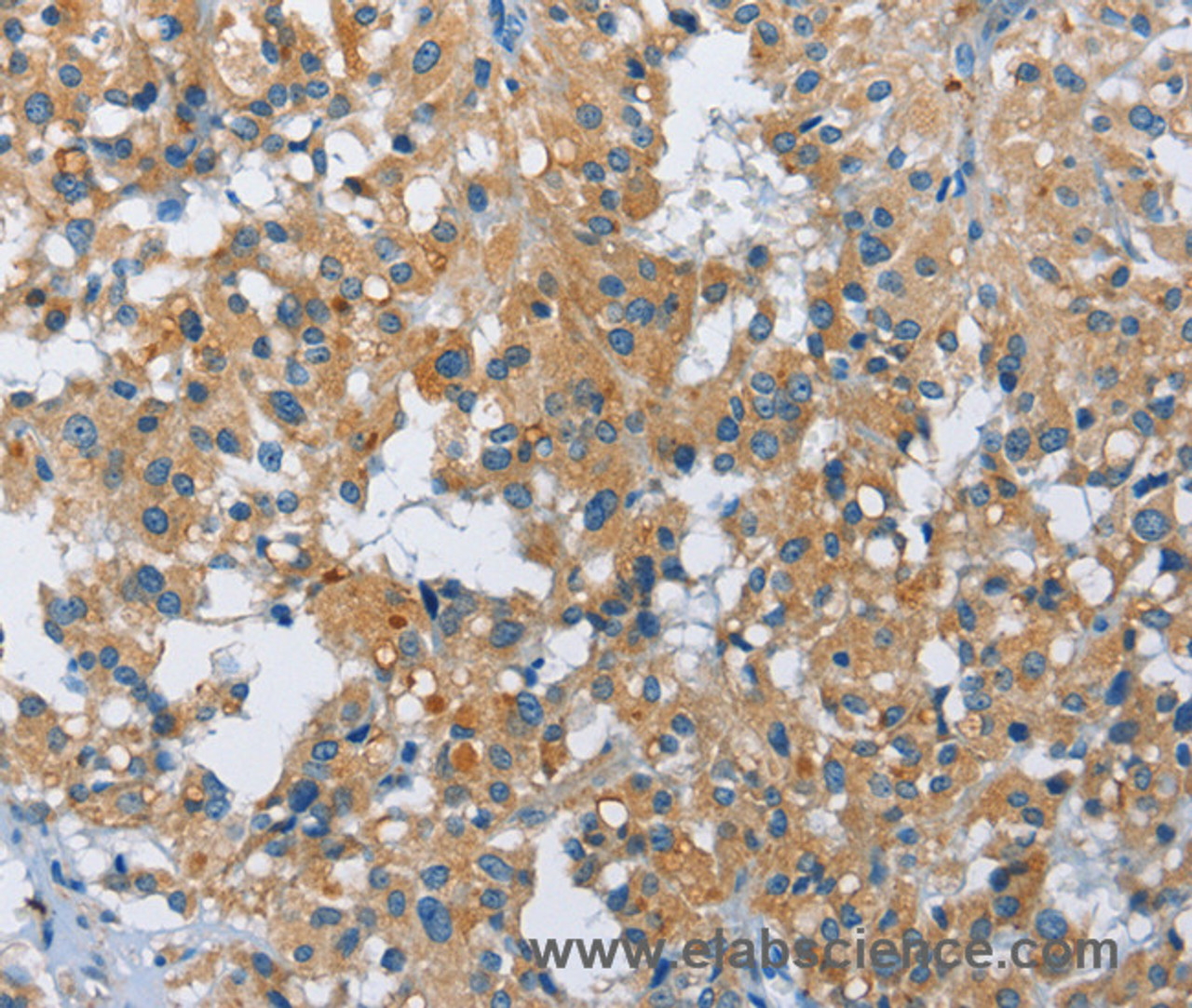 Immunohistochemistry of paraffin-embedded Human thyroid cancer using FGF9 Polyclonal Antibody at dilution of 1:40