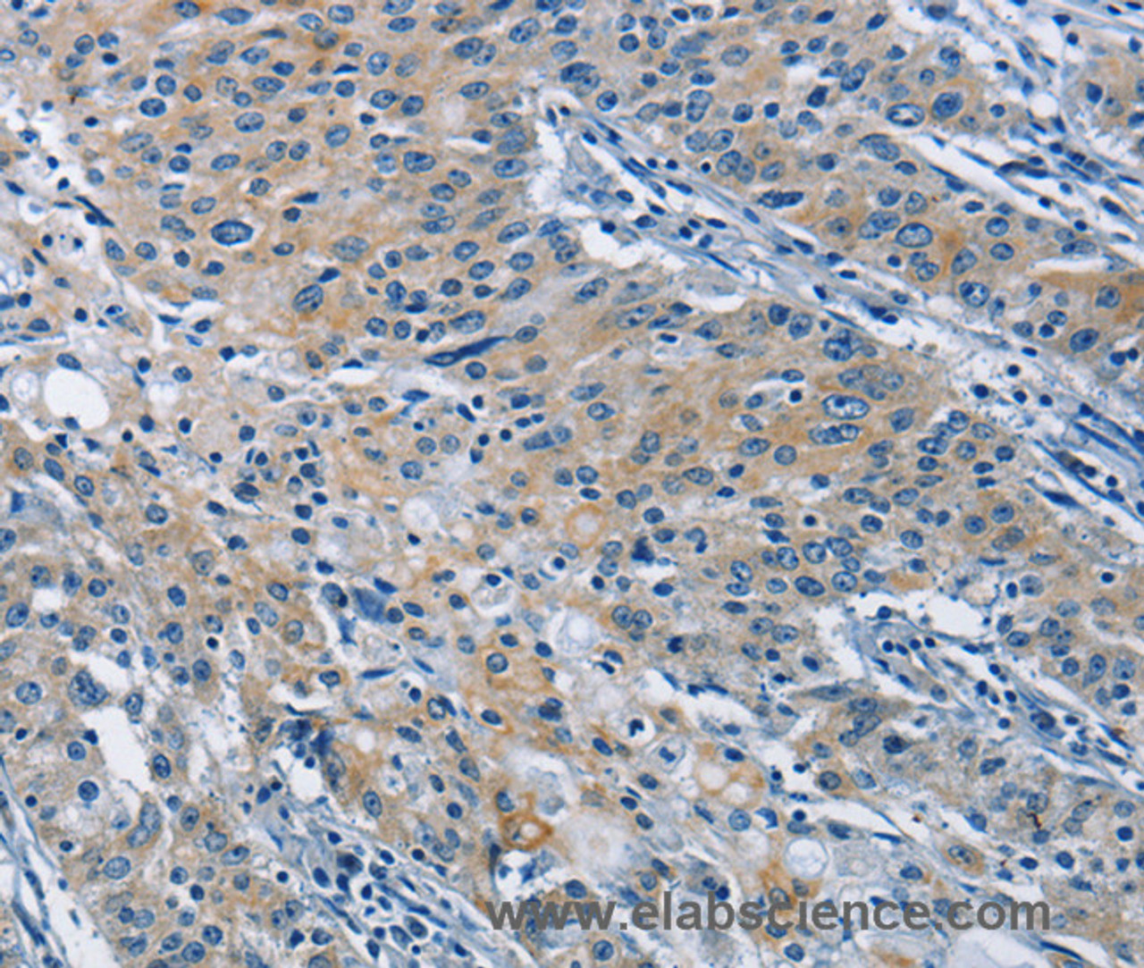 Immunohistochemistry of paraffin-embedded Human gastric cancer tissue using BMPR1B Polyclonal Antibody at dilution 1:30