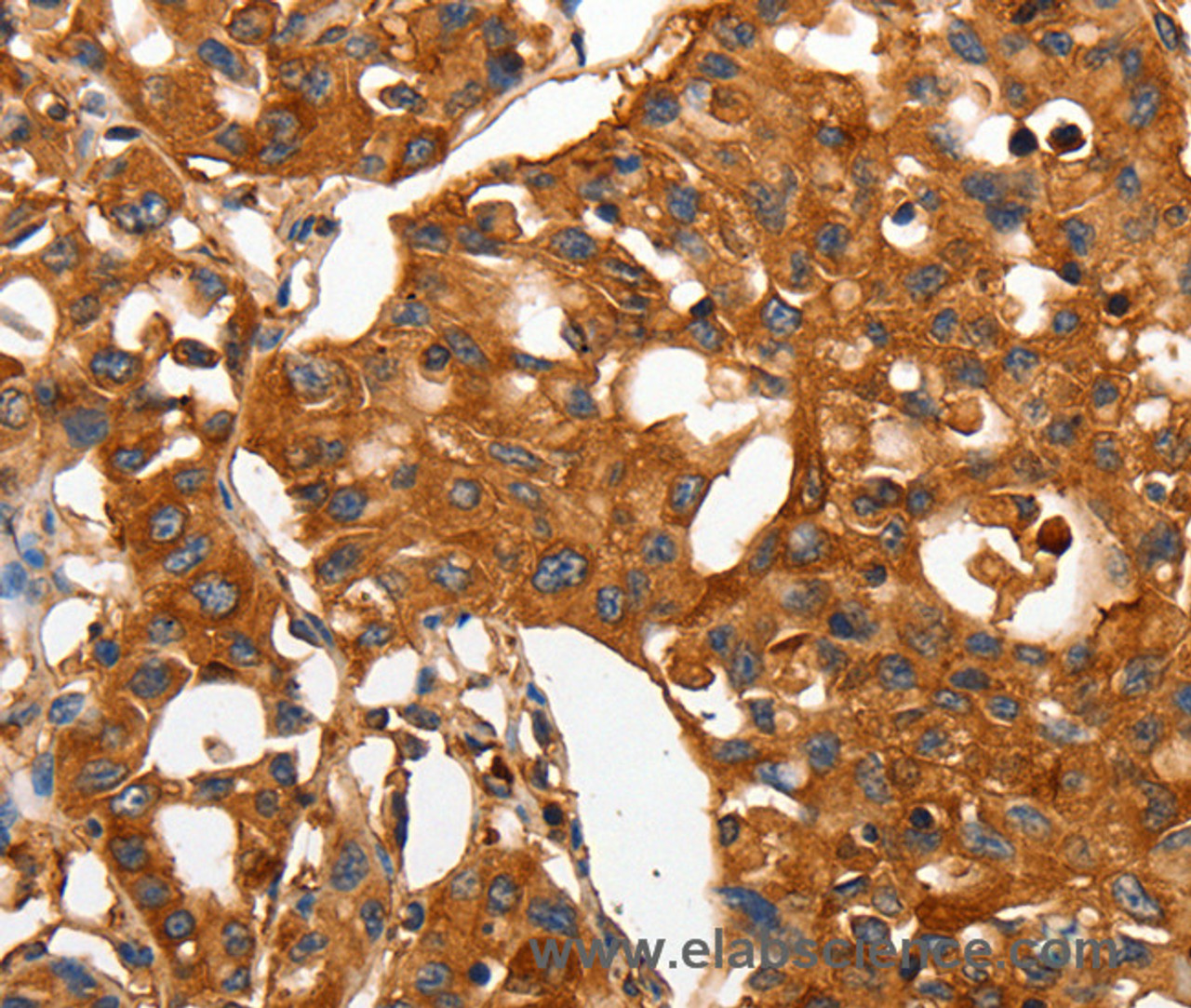 Immunohistochemistry of paraffin-embedded Human lung cancer using CAP2 Polyclonal Antibody at dilution of 1:50
