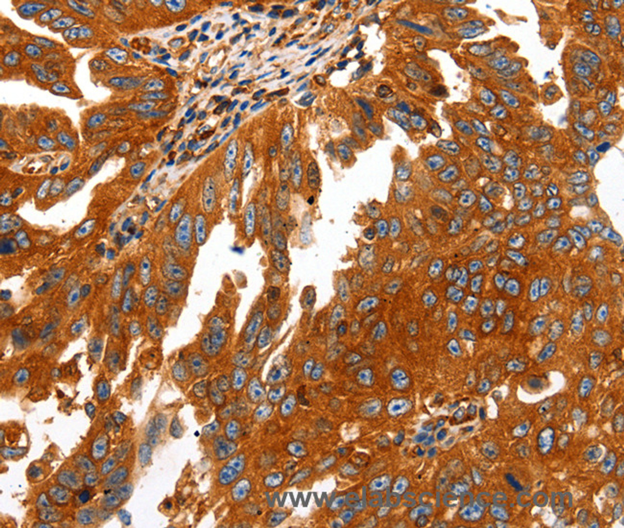 Immunohistochemistry of paraffin-embedded Human ovarian cancer using CAP2 Polyclonal Antibody at dilution of 1:50