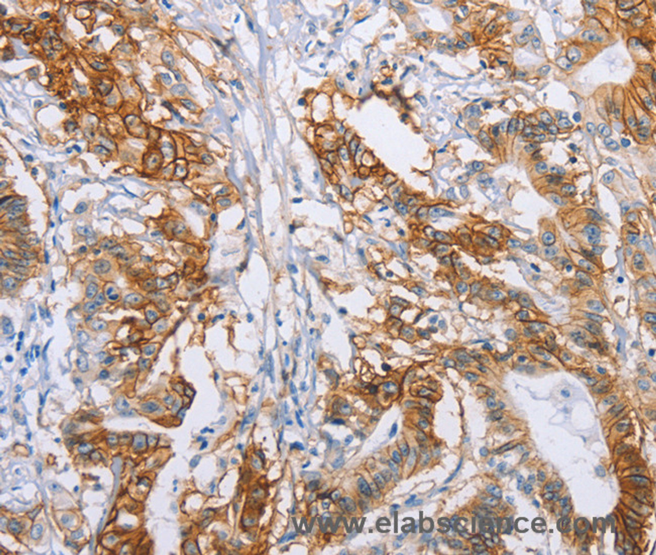 Immunohistochemistry of paraffin-embedded Human colon cancer tissue using CA9 Polyclonal Antibody at dilution 1:50
