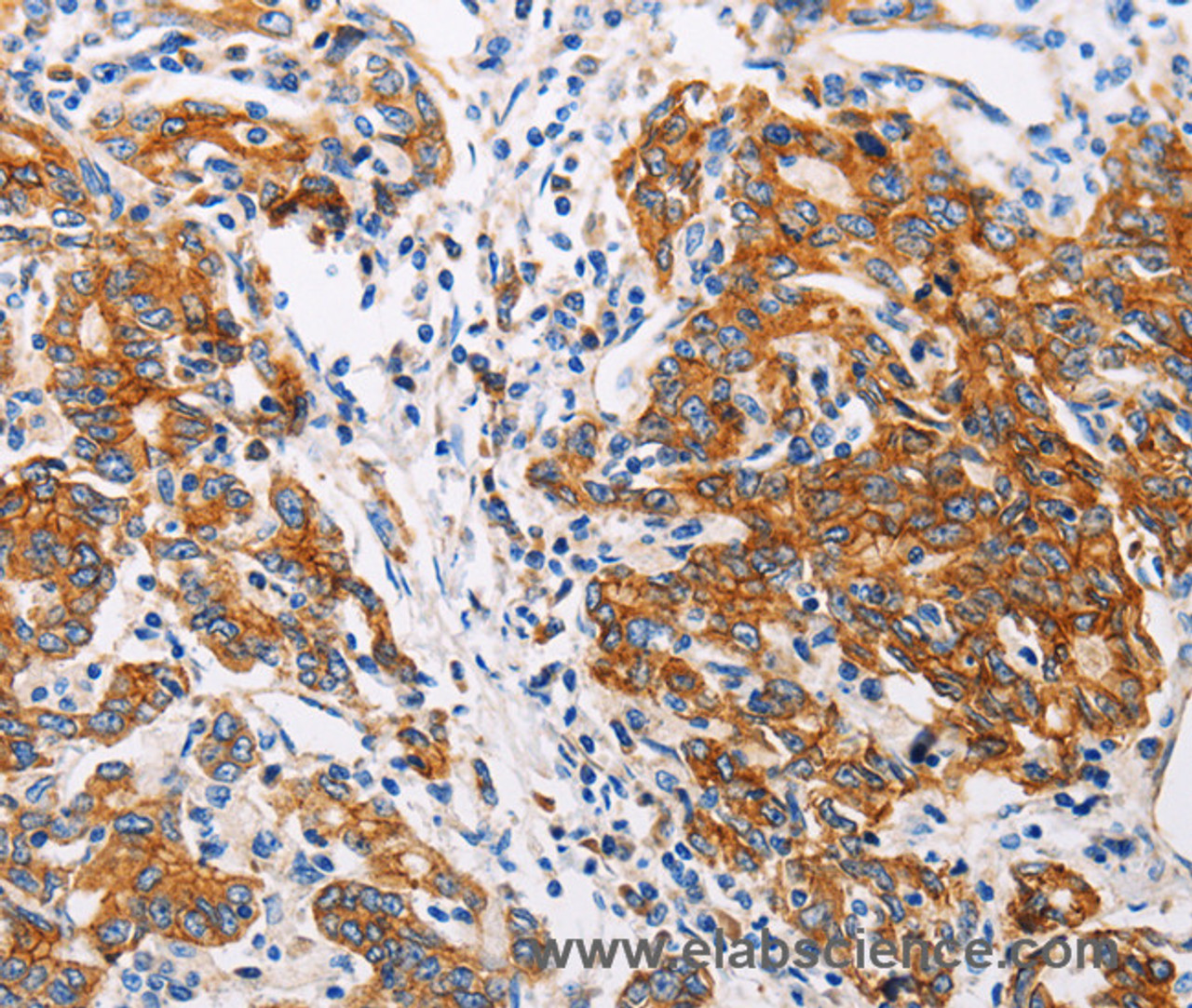 Immunohistochemistry of paraffin-embedded Human gastic cancer using CTNNA1 Polyclonal Antibody at dilution of 1:35