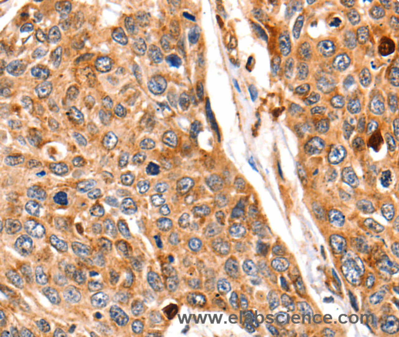 Immunohistochemistry of paraffin-embedded Human esophagus cancer tissue using Cathepsin B Polyclonal Antibody at dilution 1:140