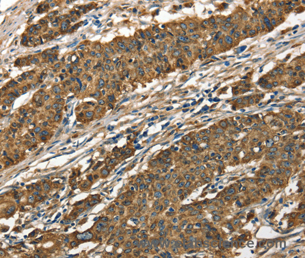 Immunohistochemistry of paraffin-embedded Human gastic cancer using Cathepsin E Polyclonal Antibody at dilution of 1:40