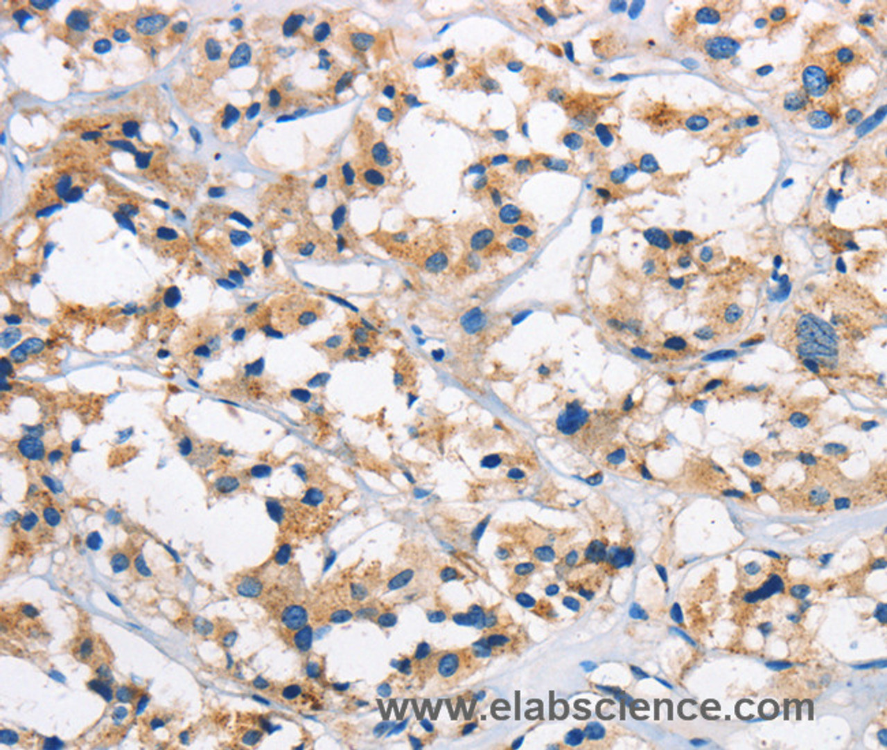 Immunohistochemistry of paraffin-embedded Human thyroid cancer tissue using Cathepsin L Polyclonal Antibody at dilution 1:50