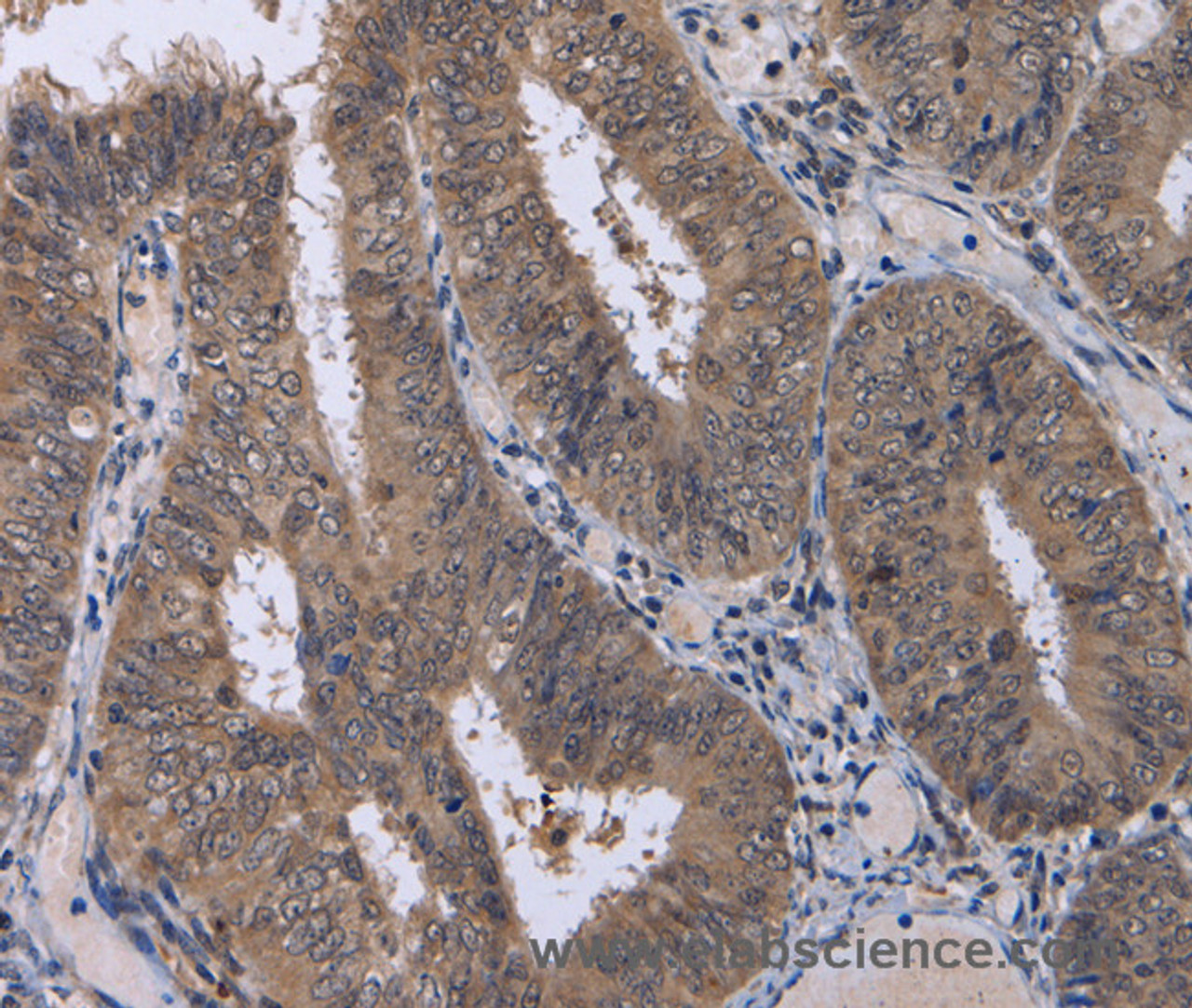 Immunohistochemistry of paraffin-embedded Human colon cancer using CDK5 Polyclonal Antibody at dilution of 1:30
