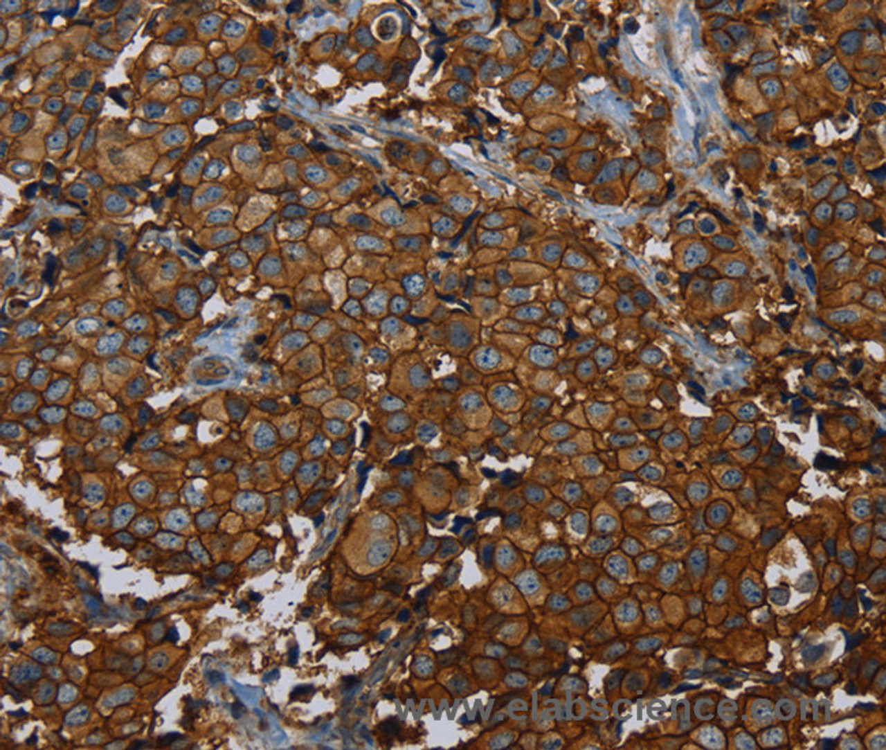 Immunohistochemistry of paraffin-embedded Human breast cancer using ERBB4 Polyclonal Antibody at dilution of 1:40