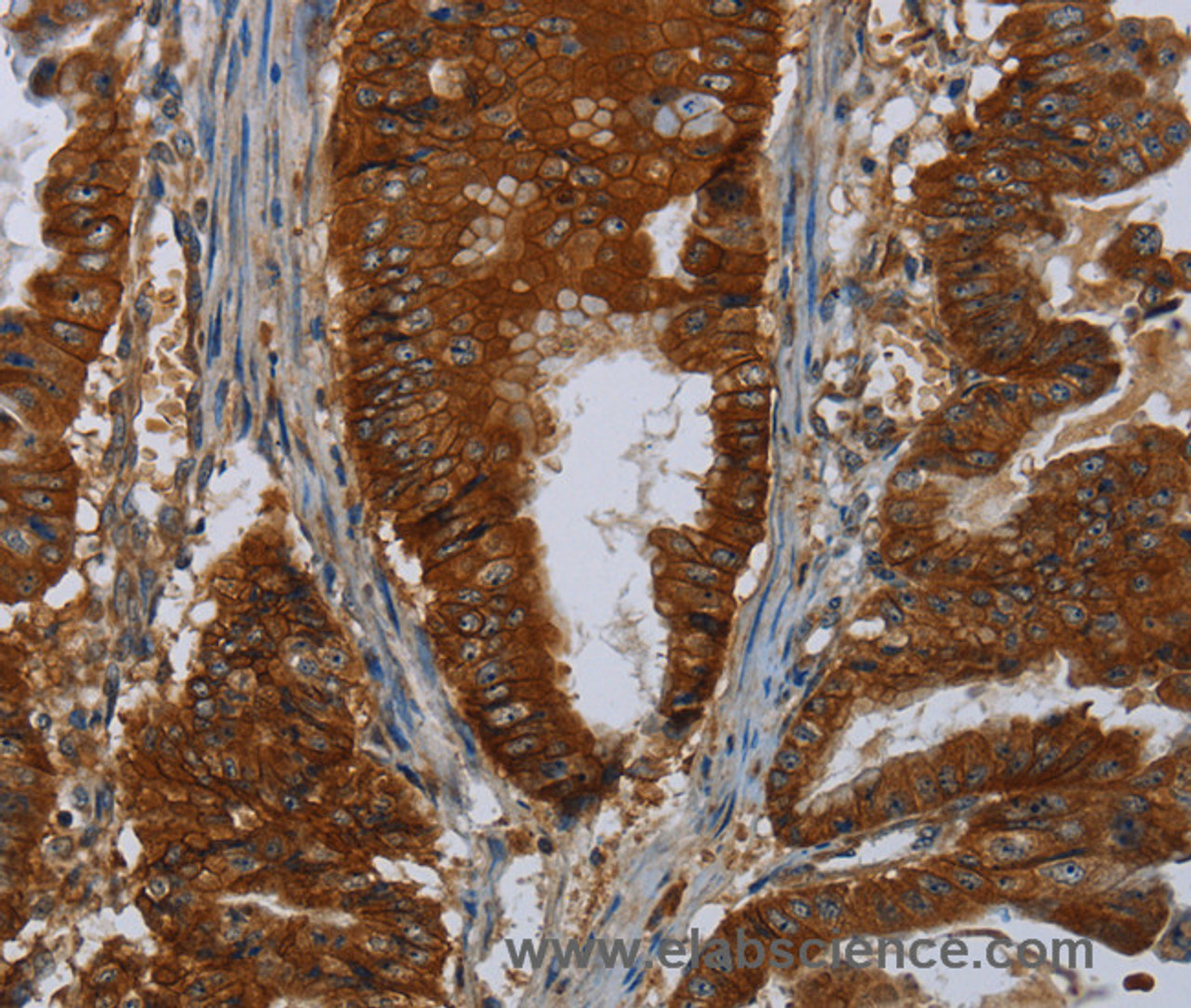 Immunohistochemistry of paraffin-embedded Human esophagus cancer using ERBB4 Polyclonal Antibody at dilution of 1:40
