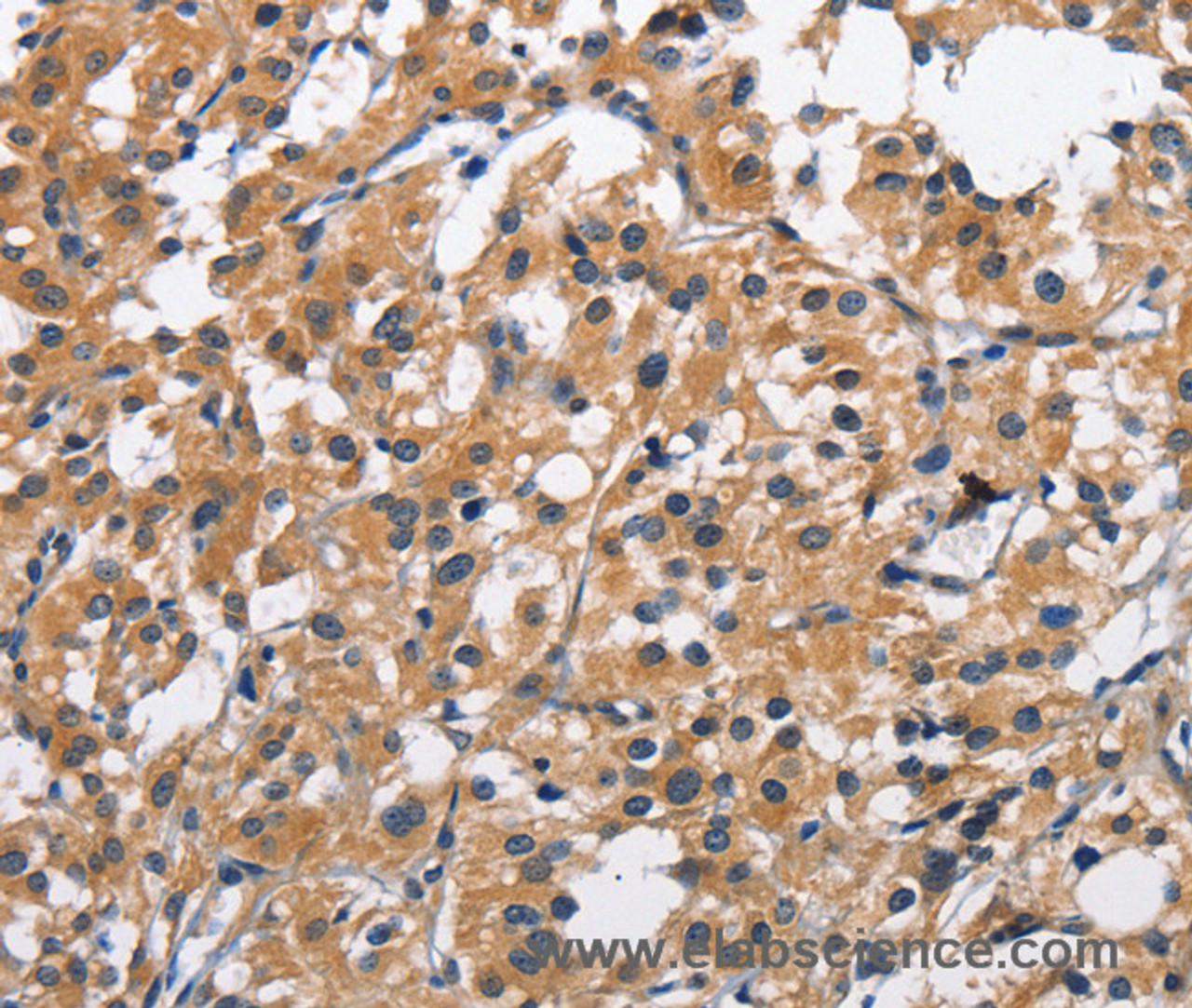 Immunohistochemistry of paraffin-embedded Human thyroid cancer tissue using CLEC2D Polyclonal Antibody at dilution 1:70