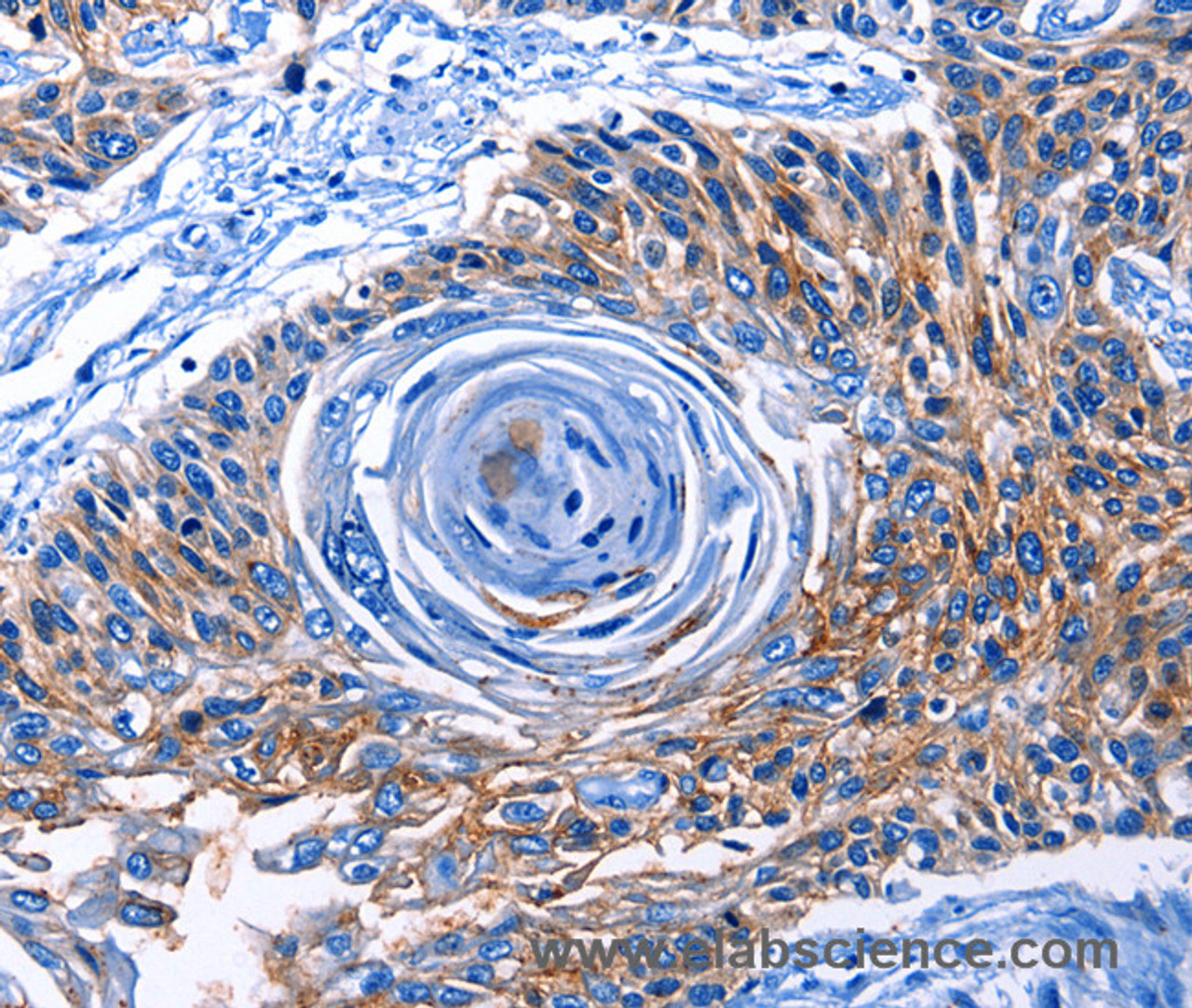 Immunohistochemistry of paraffin-embedded Human esophagus cancer tissue using CLEC2B Polyclonal Antibody at dilution 1:50