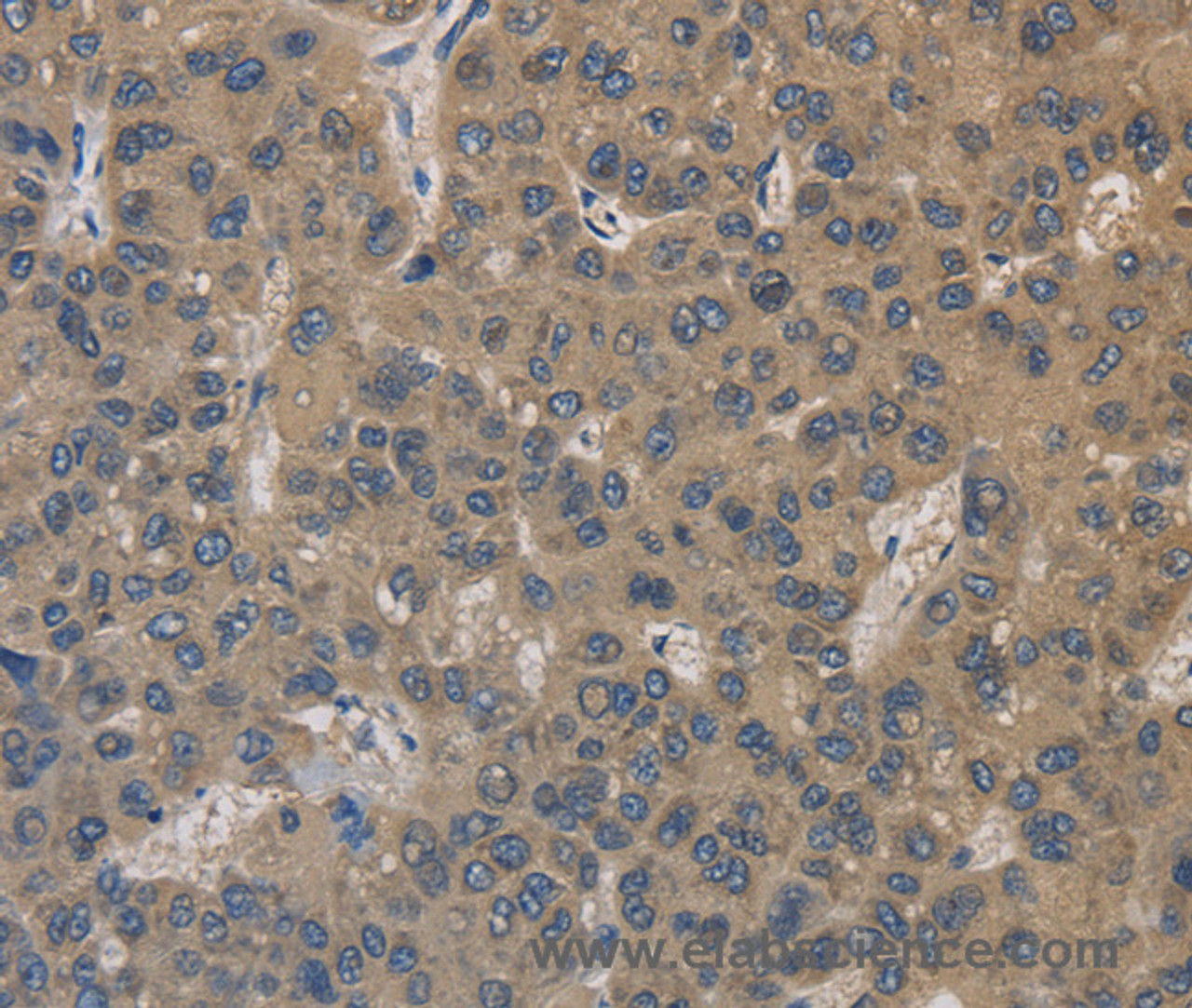 Immunohistochemistry of paraffin-embedded Human liver cancer using EMC8 Polyclonal Antibody at dilution of 1:30