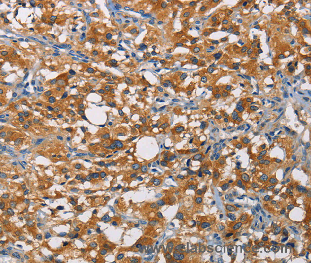 Immunohistochemistry of paraffin-embedded Human thyroid cancer tissue using CRTAM Polyclonal Antibody at dilution of 1:60