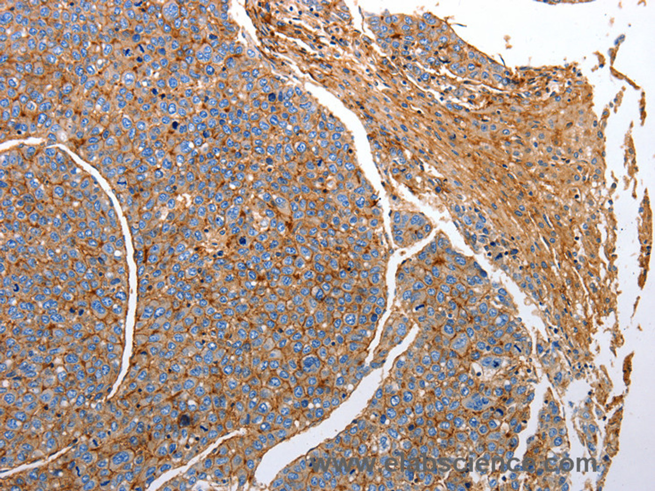 Immunohistochemistry of paraffin-embedded Human liver cancer tissue using CD151 Polyclonal Antibody at dilution 1:25