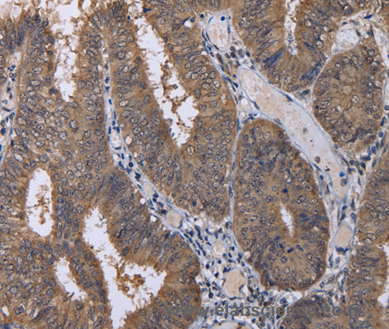 Immunohistochemistry of paraffin-embedded Human colon cancer using CUL3 Polyclonal Antibody at dilution of 1:30