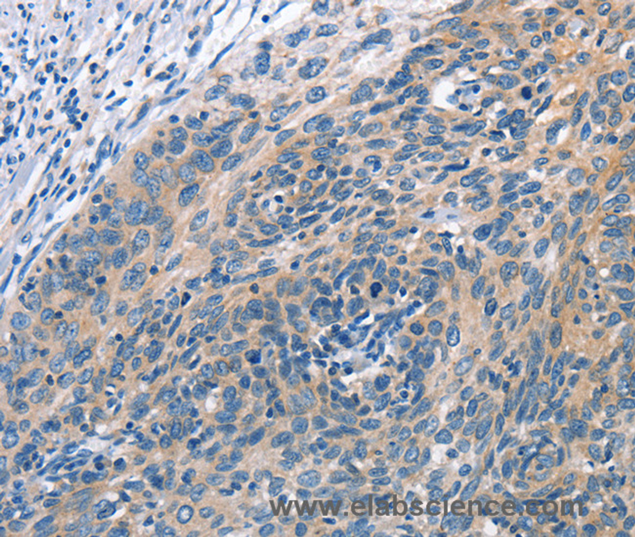 Immunohistochemistry of paraffin-embedded Human cervical cancer tissue using CUL7 Polyclonal Antibody at dilution 1:50