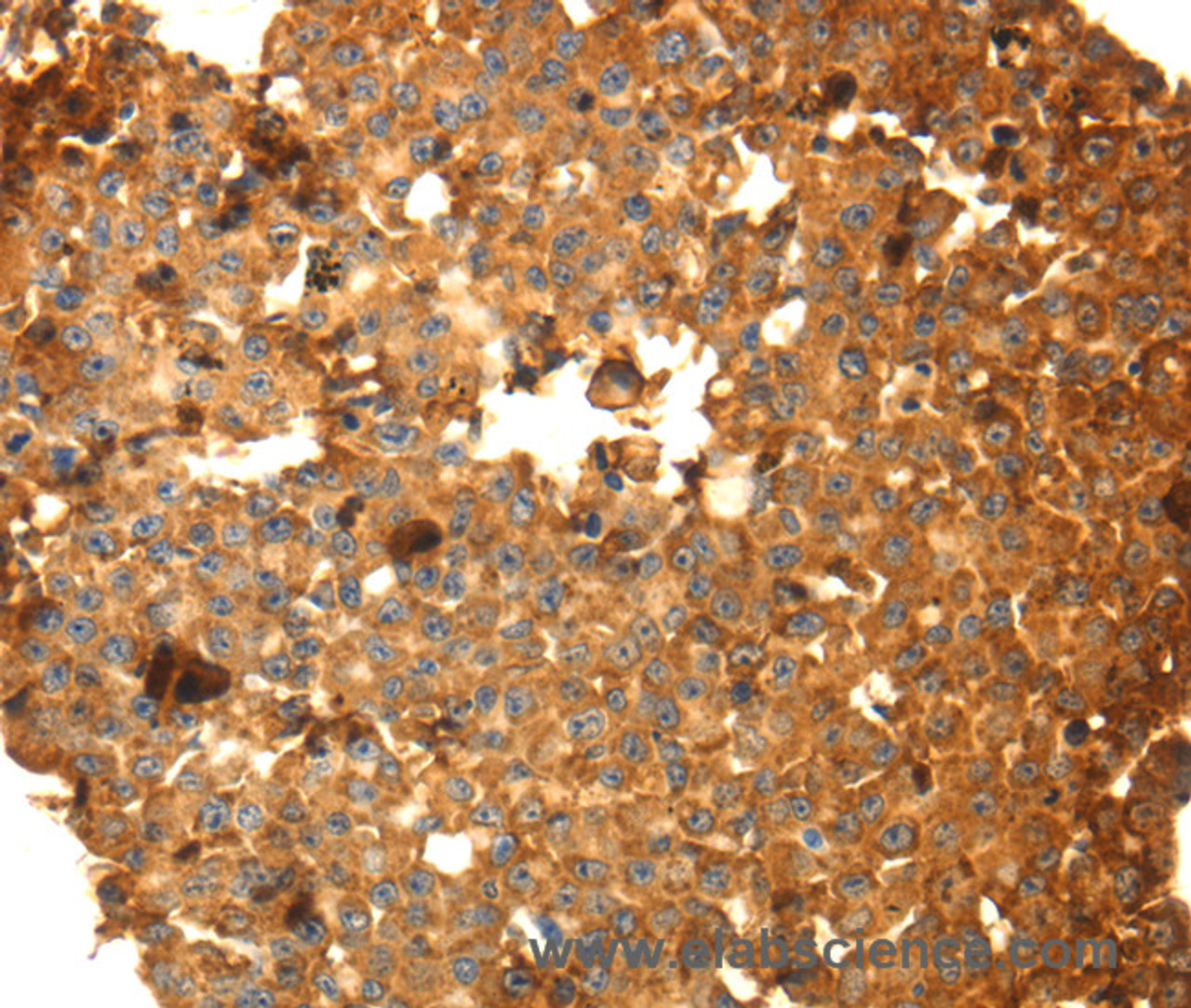 Immunohistochemistry of paraffin-embedded Human breast cancer using DRD5 Polyclonal Antibody at dilution of 1:40