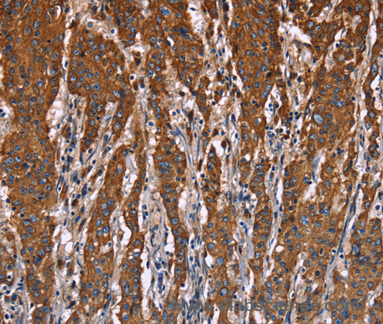 Immunohistochemistry of paraffin-embedded Human gastic cancer using CD107b Polyclonal Antibody at dilution of 1:40