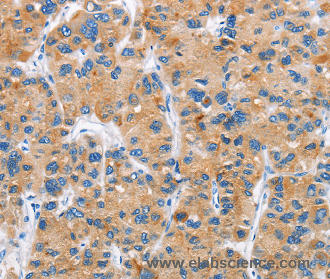 Immunohistochemistry of paraffin-embedded Human liver cancer tissue using DKK2 Polyclonal Antibody at dilution 1:60