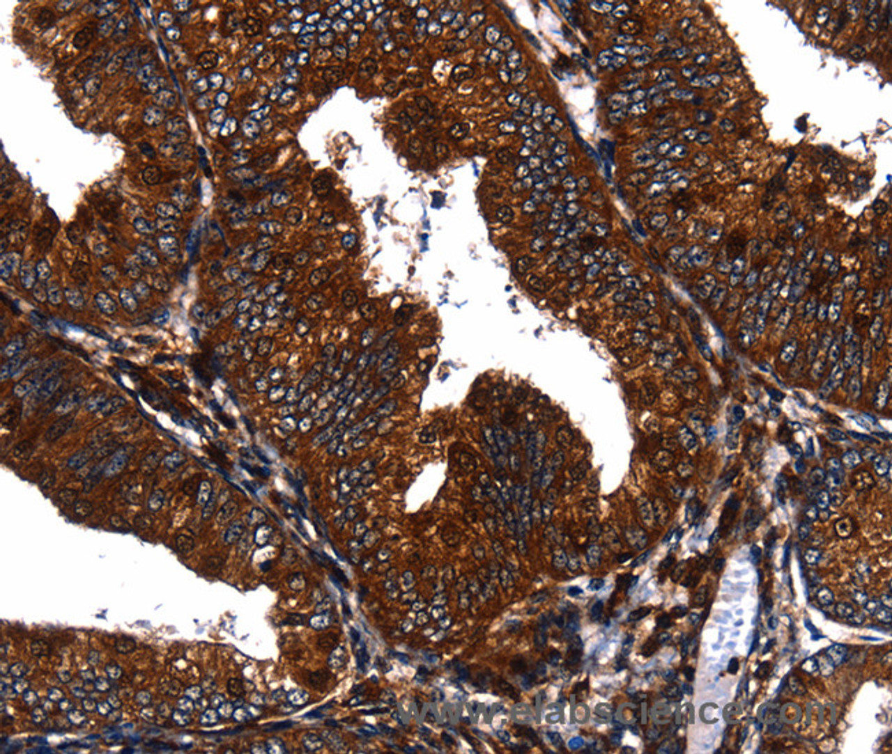 Immunohistochemistry of paraffin-embedded Human cervical cancer tissue using EGF Polyclonal Antibody at dilution 1:60