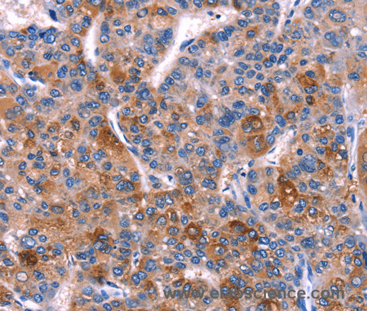 Immunohistochemistry of paraffin-embedded Human liver cancer tissue using DUSP13 Polyclonal Antibody at dilution 1:60