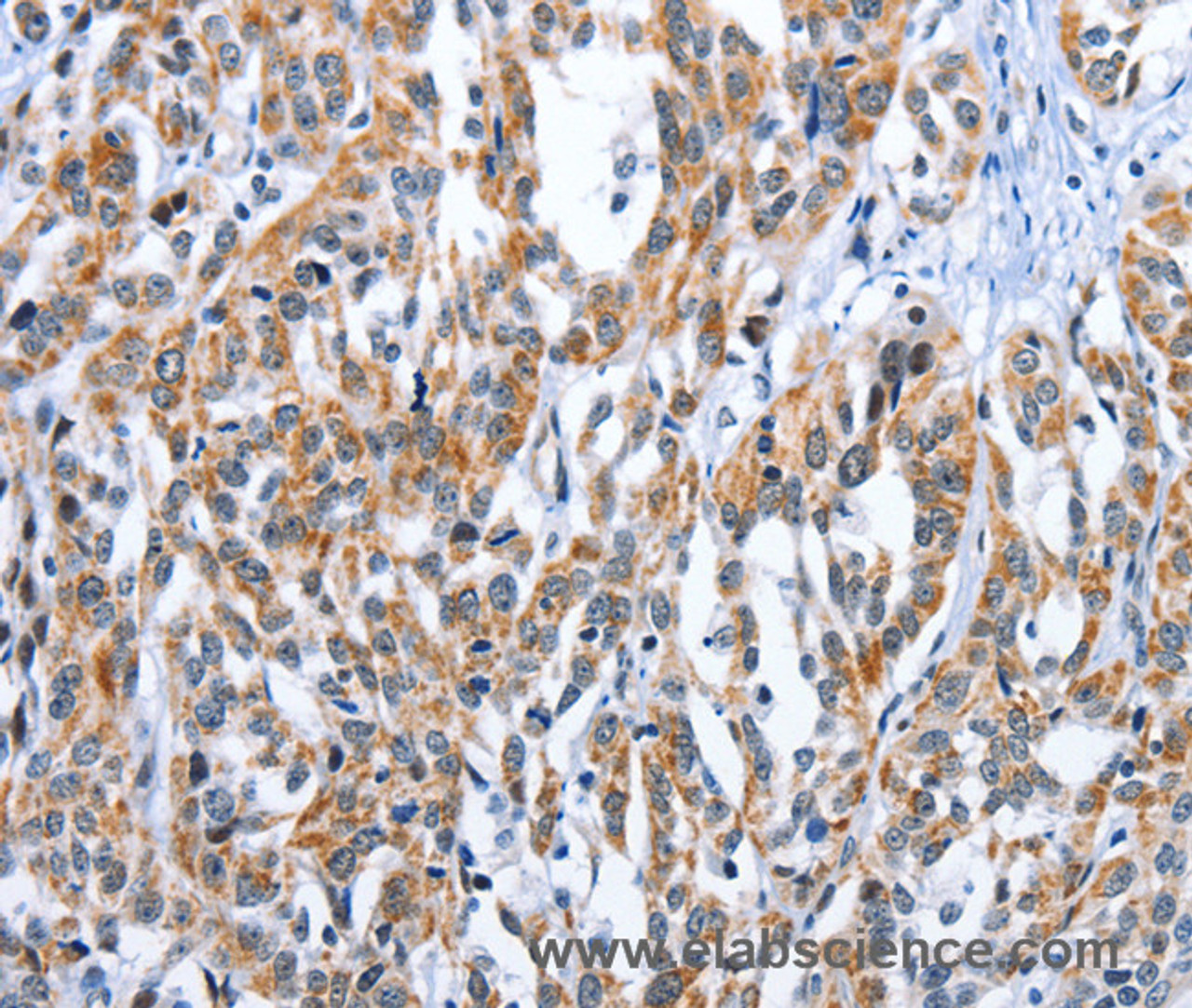 Immunohistochemistry of paraffin-embedded Human esophagus cancer tissue using EDN3 Polyclonal Antibody at dilution 1:30