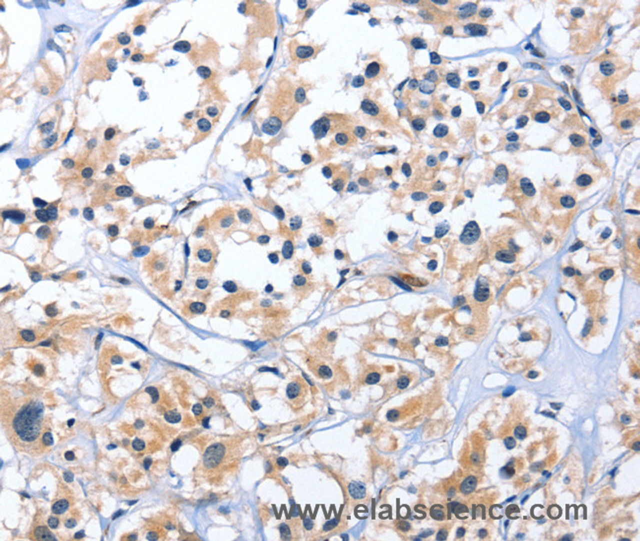 Immunohistochemistry of paraffin-embedded Human thyroid cancer tissue using EDN3 Polyclonal Antibody at dilution 1:30