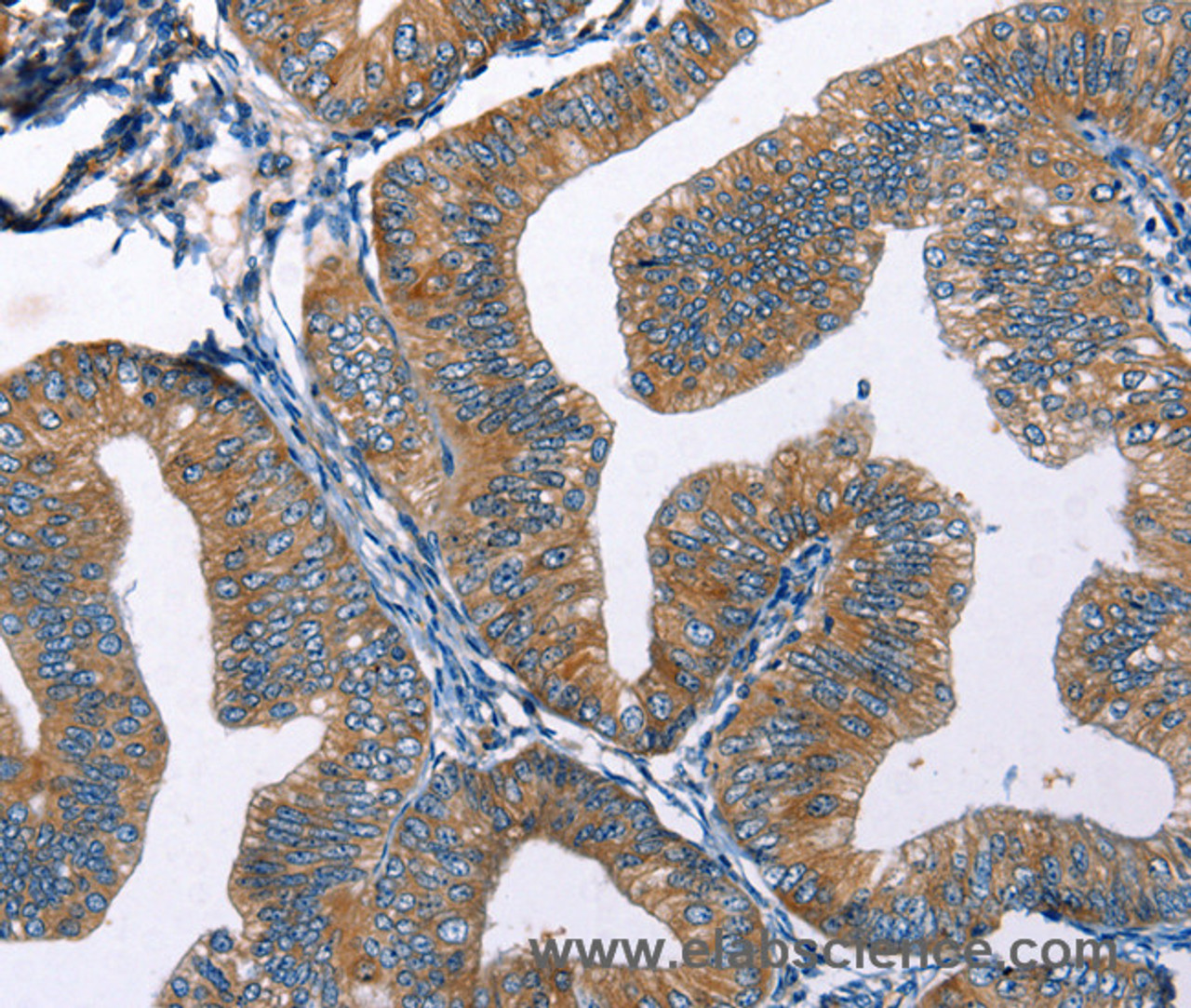 Immunohistochemistry of paraffin-embedded Human cervical cancer tissue using EDN2 Polyclonal Antibody at dilution 1:50
