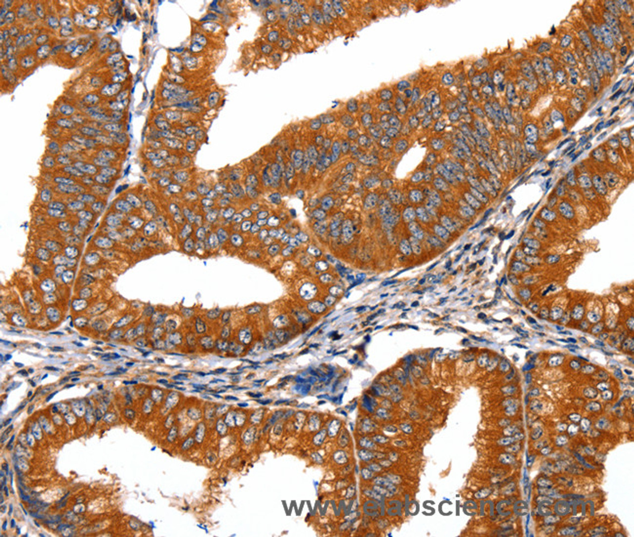 Immunohistochemistry of paraffin-embedded Human cervical cancer tissue using FGFR1 Polyclonal Antibody at dilution 1:60