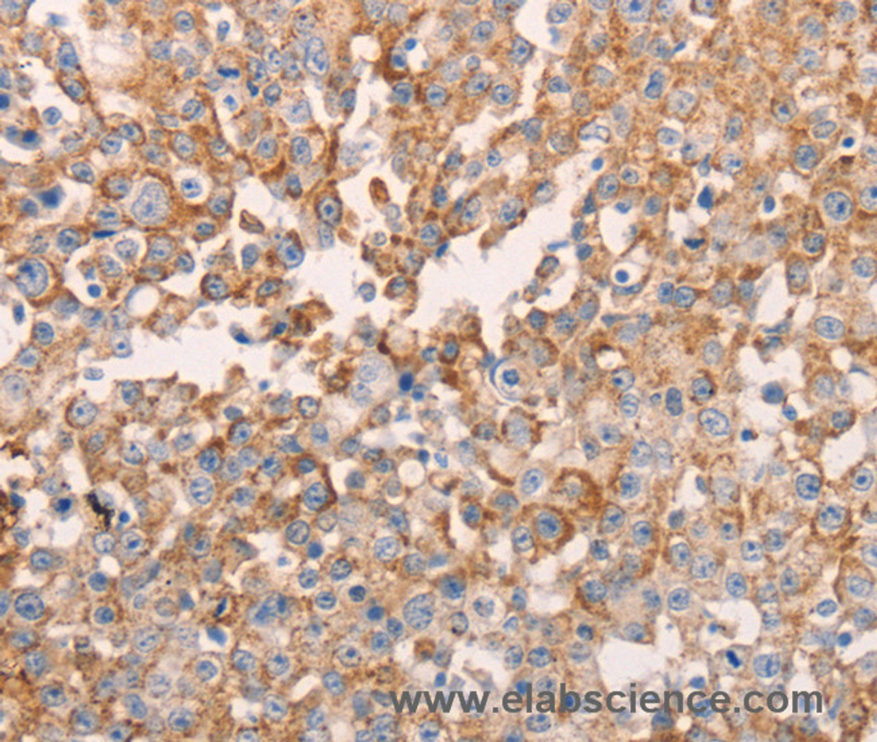 Immunohistochemistry of paraffin-embedded Human breast cancer using GNA11 Polyclonal Antibody at dilution of 1:40